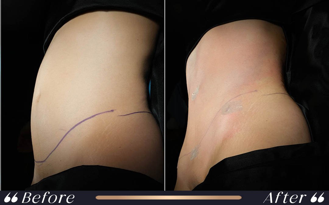 Flying after liposuction and international patient recovery