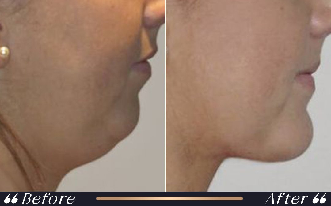 Liposuction in Turkey recovery planning at Yesilkoy Clinic