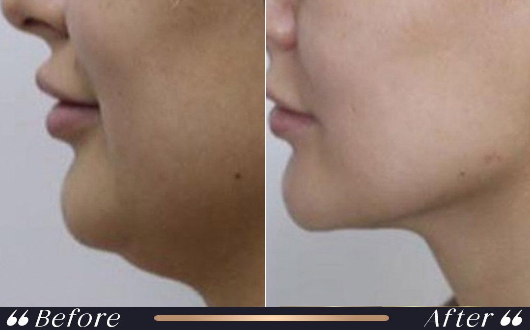 When can I fly after liposuction surgery in Turkey