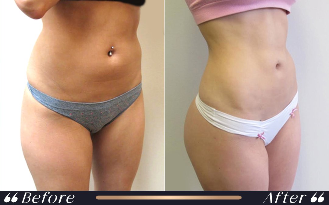 When can I fly after liposuction at Yesilkoy Clinic