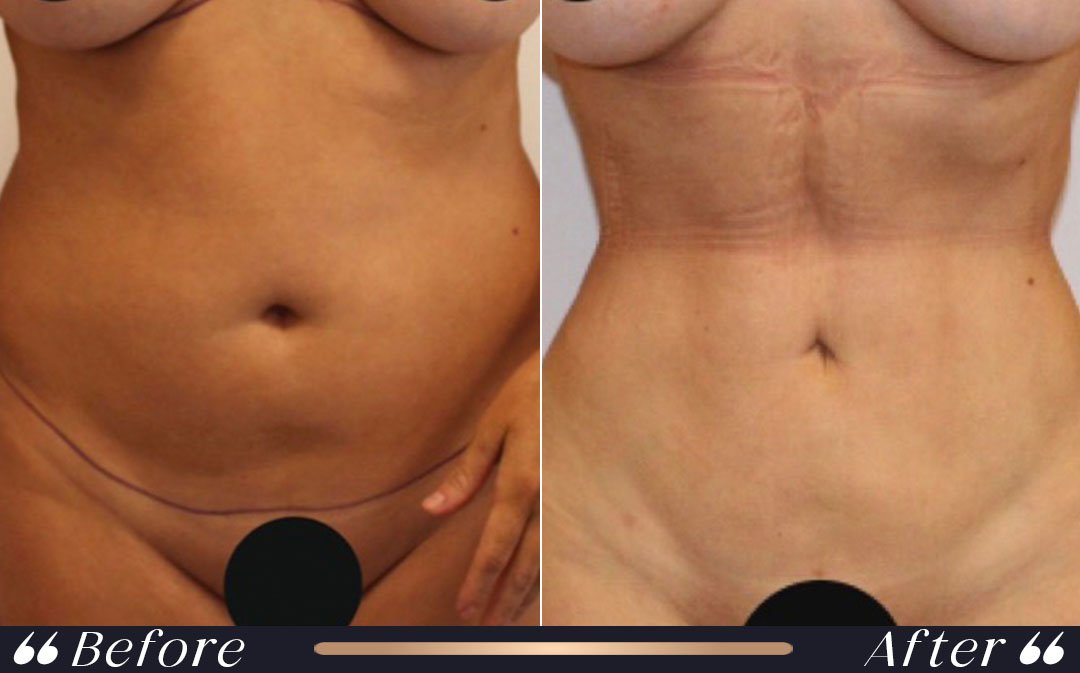 Tummy Tuck at Yesilkoy Clinic
