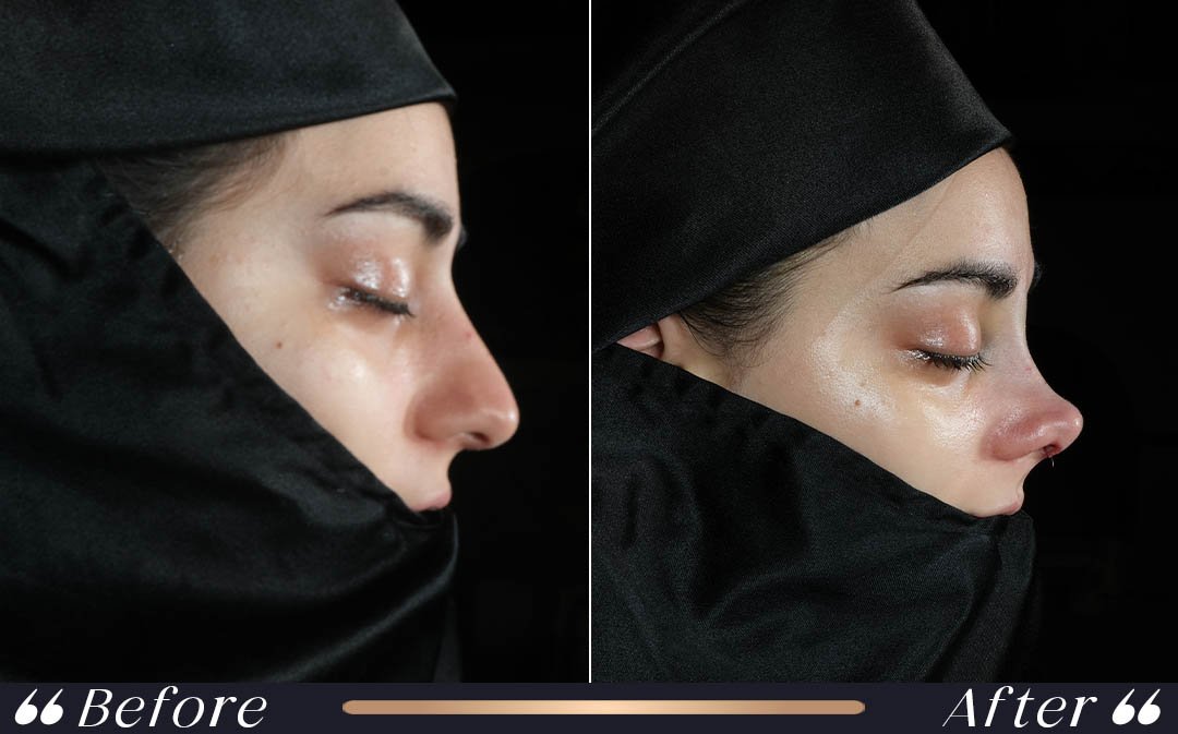 When can I fly after rhinoplasty recovery at Yeşilköy Clinic Istanbul