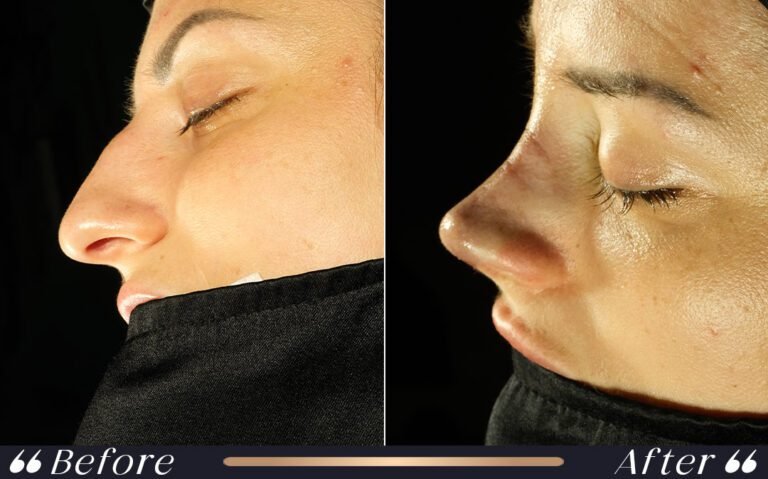 rhinoplasty
