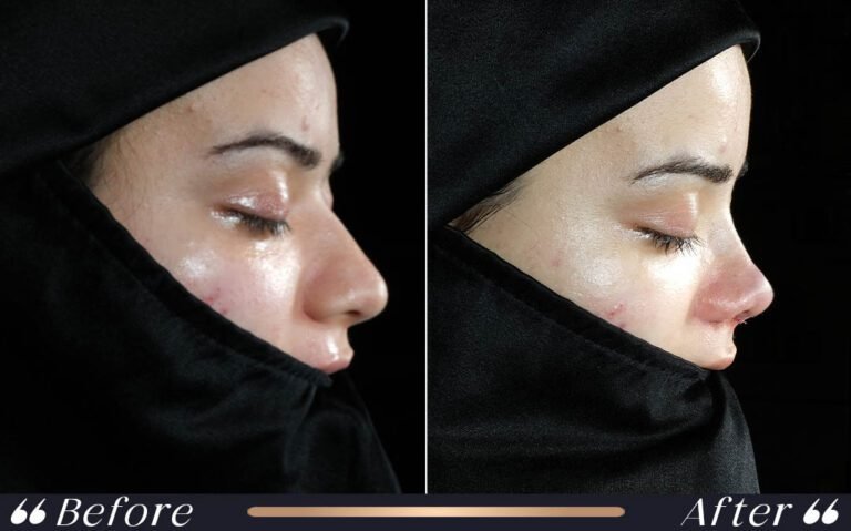 rhinoplasty3