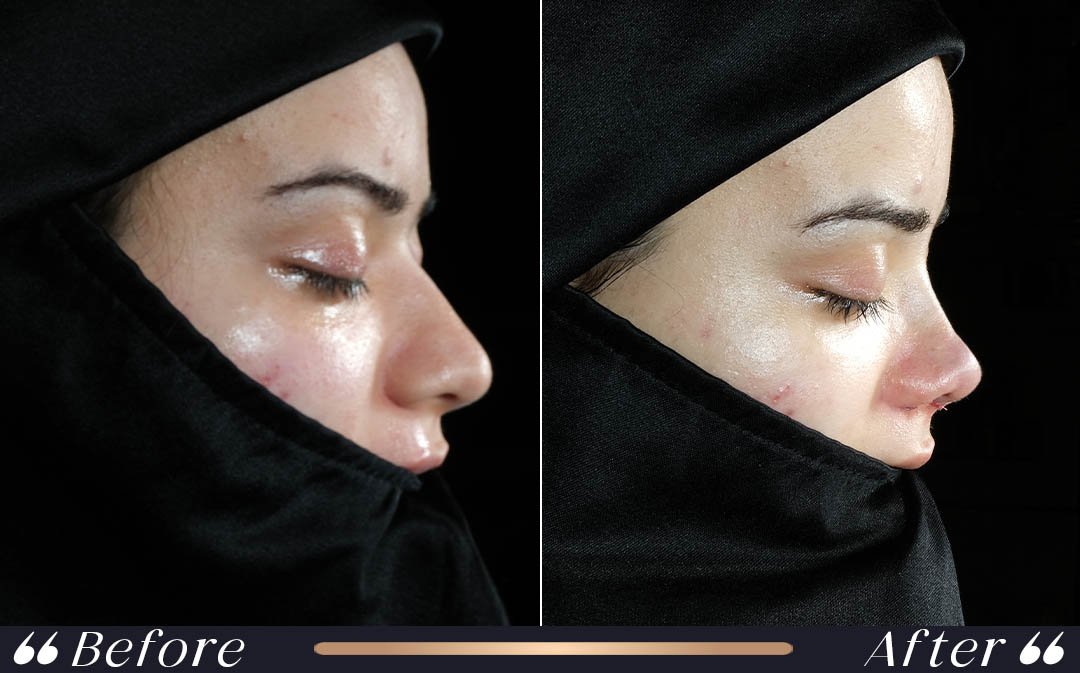 Rhinoplasty Result 3