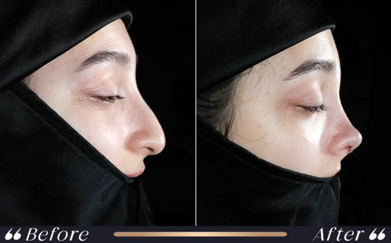 rhinoplasty4