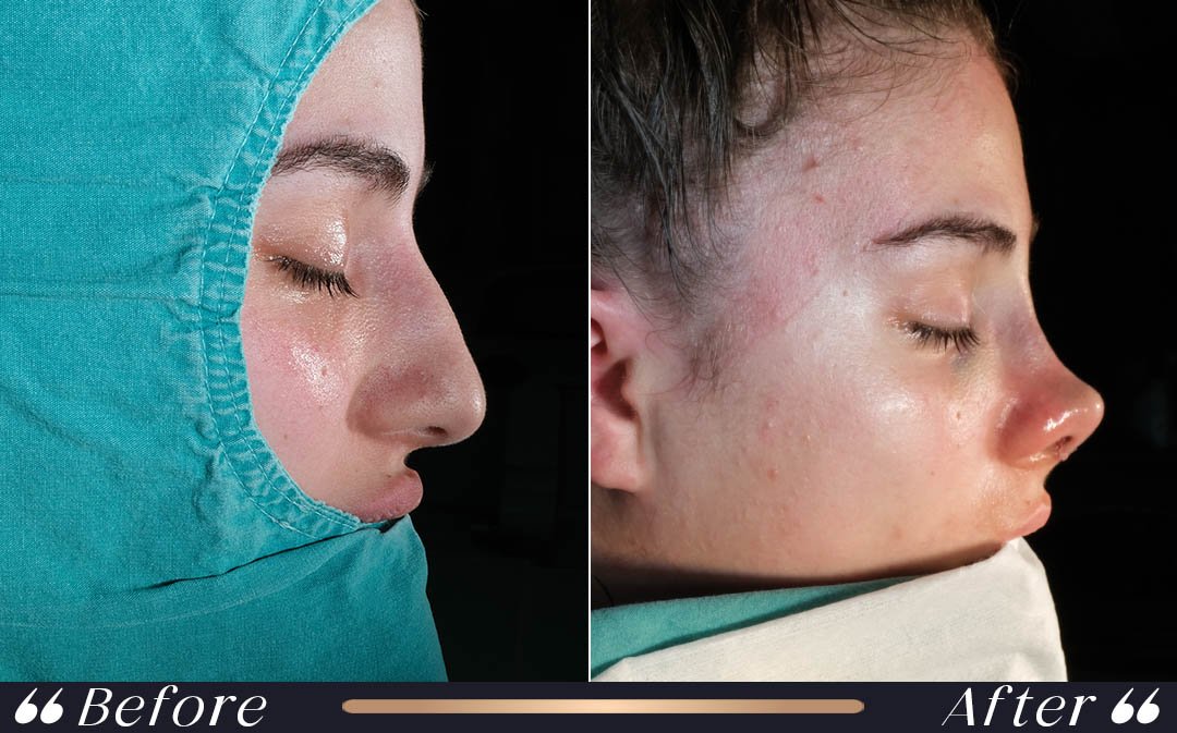 When can I fly after rhinoplasty nasal splint recovery