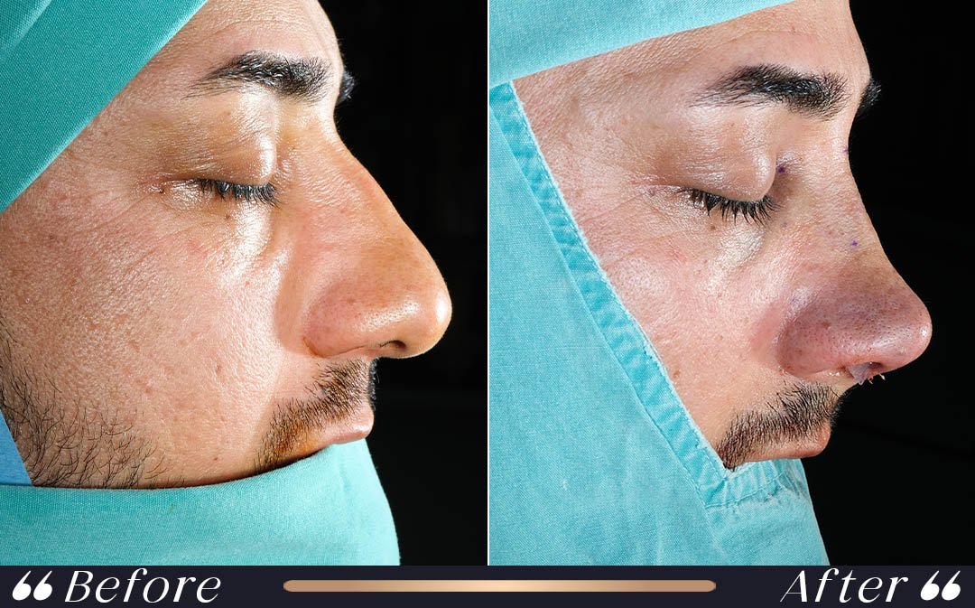 When can I fly after rhinoplasty specialist doctor Yeşilköy Clinic