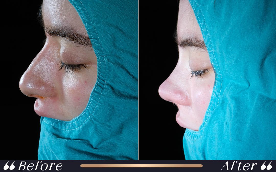 Rhinoplasty recovery long term healing and final result