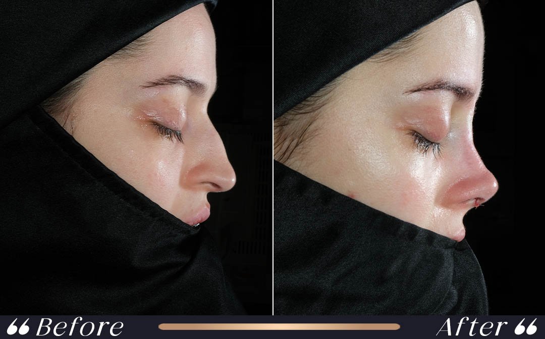 Septorhinoplasty at Yesilkoy Clinic