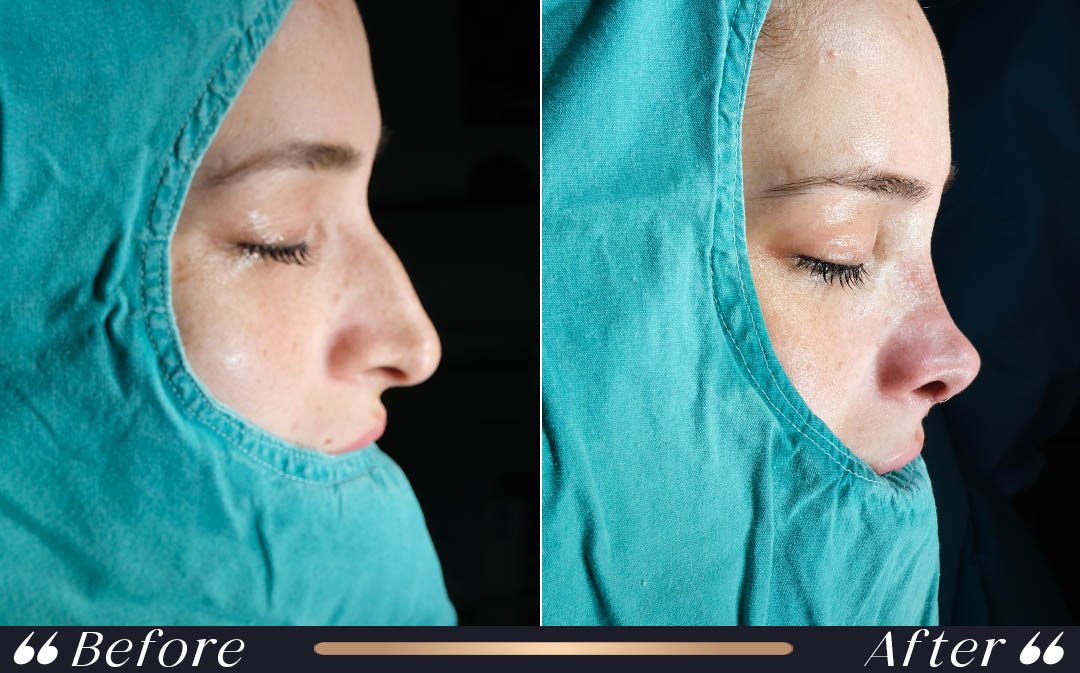 Septorhinoplasty at Yesilkoy Clinic