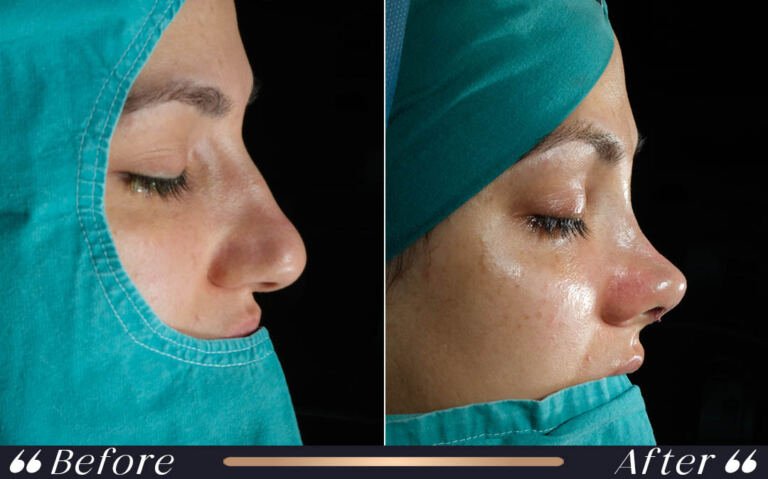 rhinoplasty_6