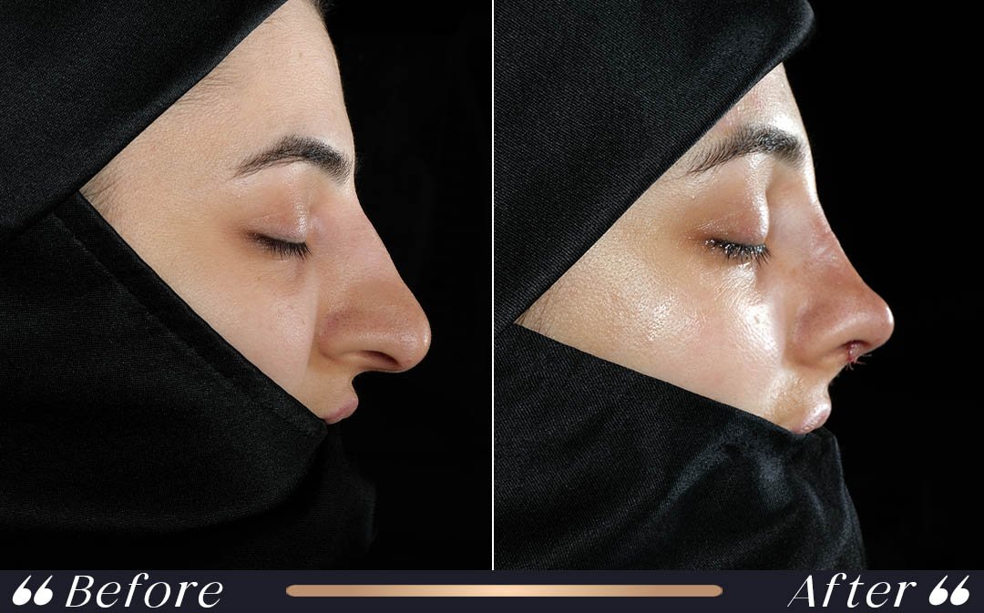 Revision Rhinoplasty at Yesilkoy Clinic