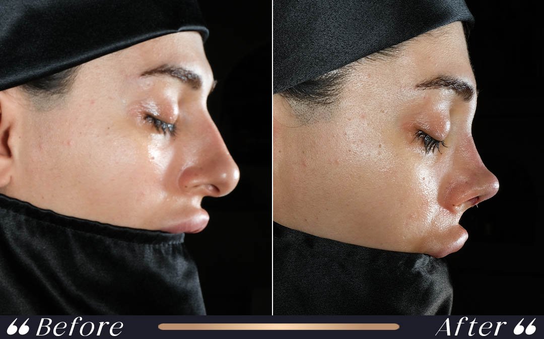 Revision Rhinoplasty at Yesilkoy Clinic