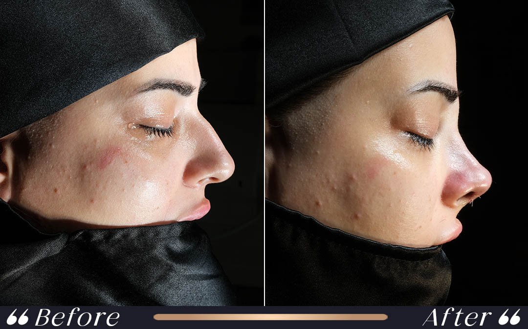 Rhinoplasty in Turkey package and nose surgery consultation in Istanbul