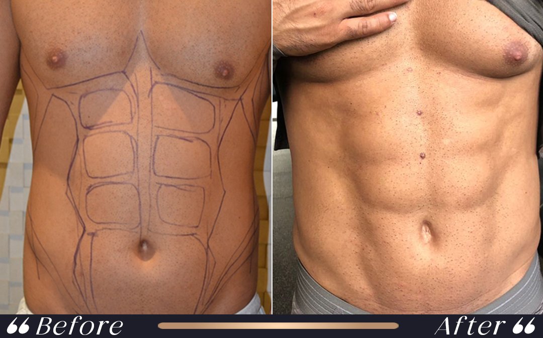 Body Contouring consultation at Yesilkoy Clinic