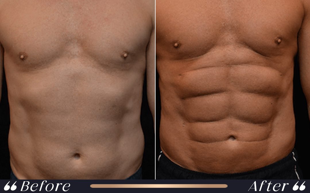 Six Pack Before and After