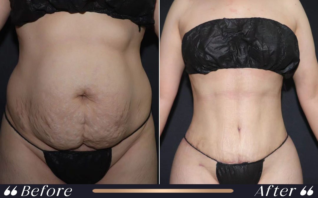 liposuction vs tummy tuck comparison at Yesilkoy Clinic
