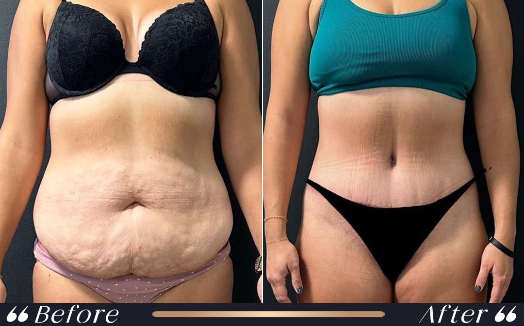 tummy tuck procedure in liposuction vs tummy tuck comparison