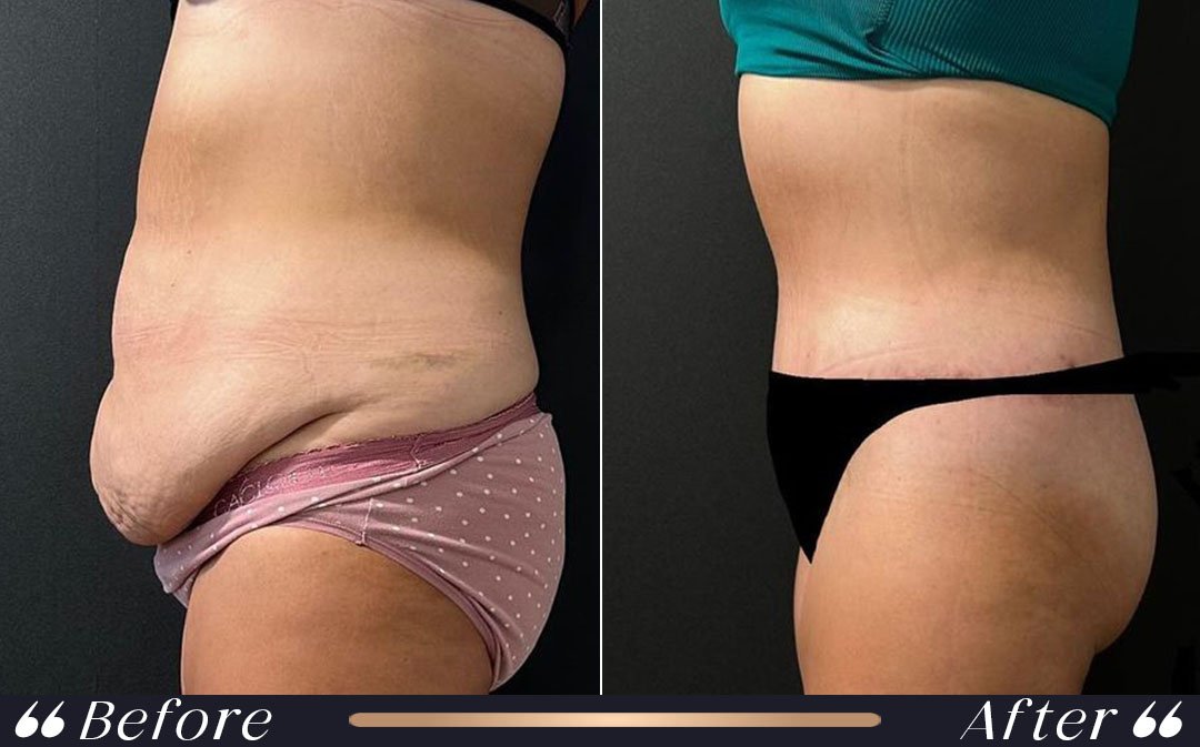 Tummy tuck Turkey recovery and specialist care at Yeşilköy Clinic