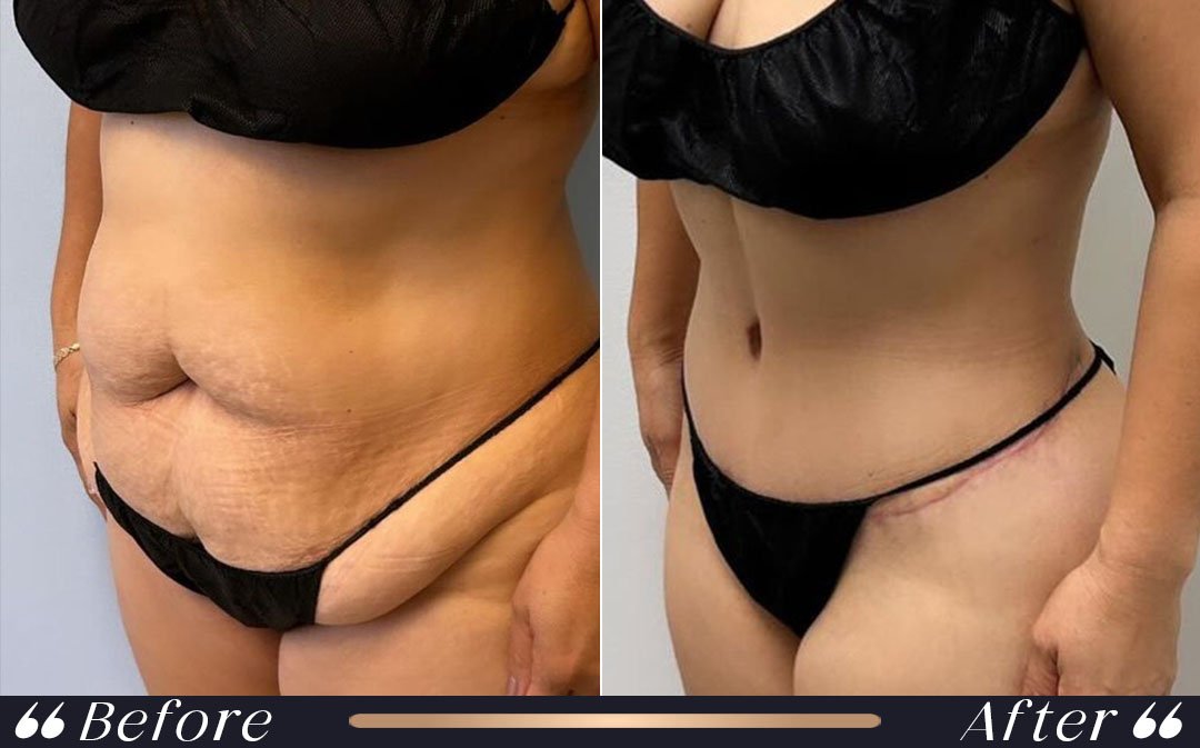 Tummy tuck surgery Turkey specialist doctors Yeşilköy Clinic