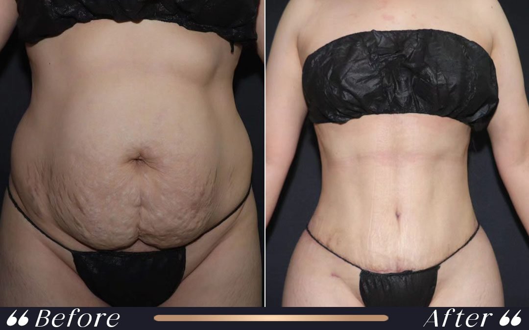 Tummy Tuck Before and After