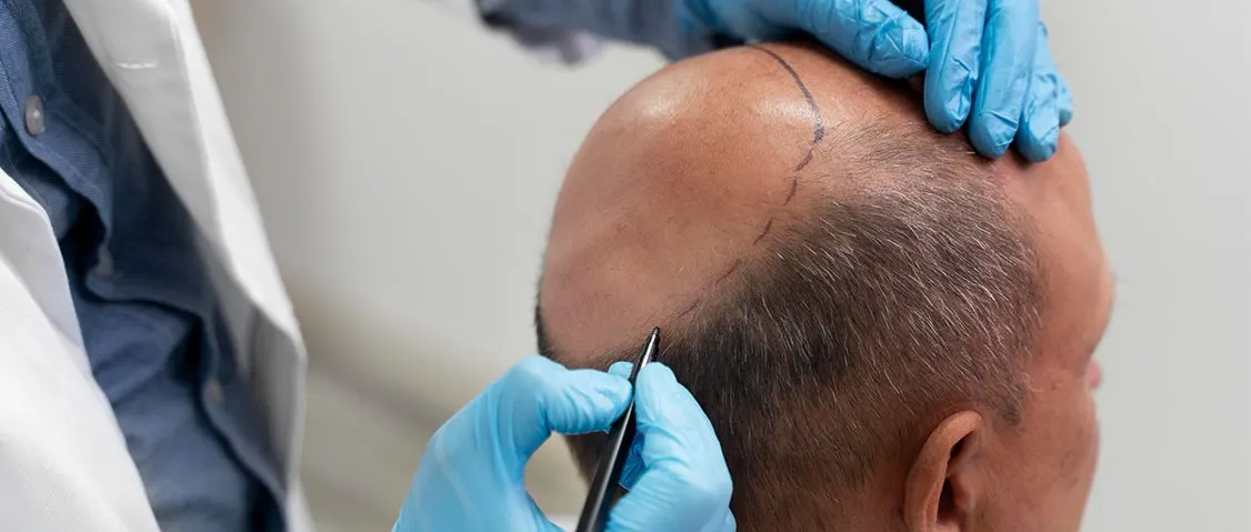 First days of hair transplant recovery Yeşilköy Clinic