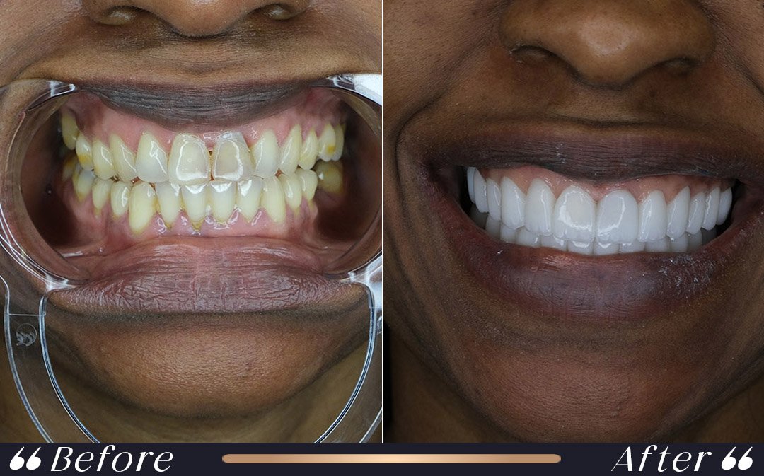 veneers vs zirconium crowns dental treatment differences