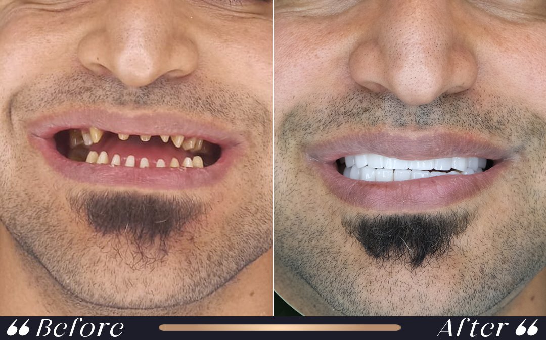 zirconia crowns in veneers vs zirconium crowns comparison