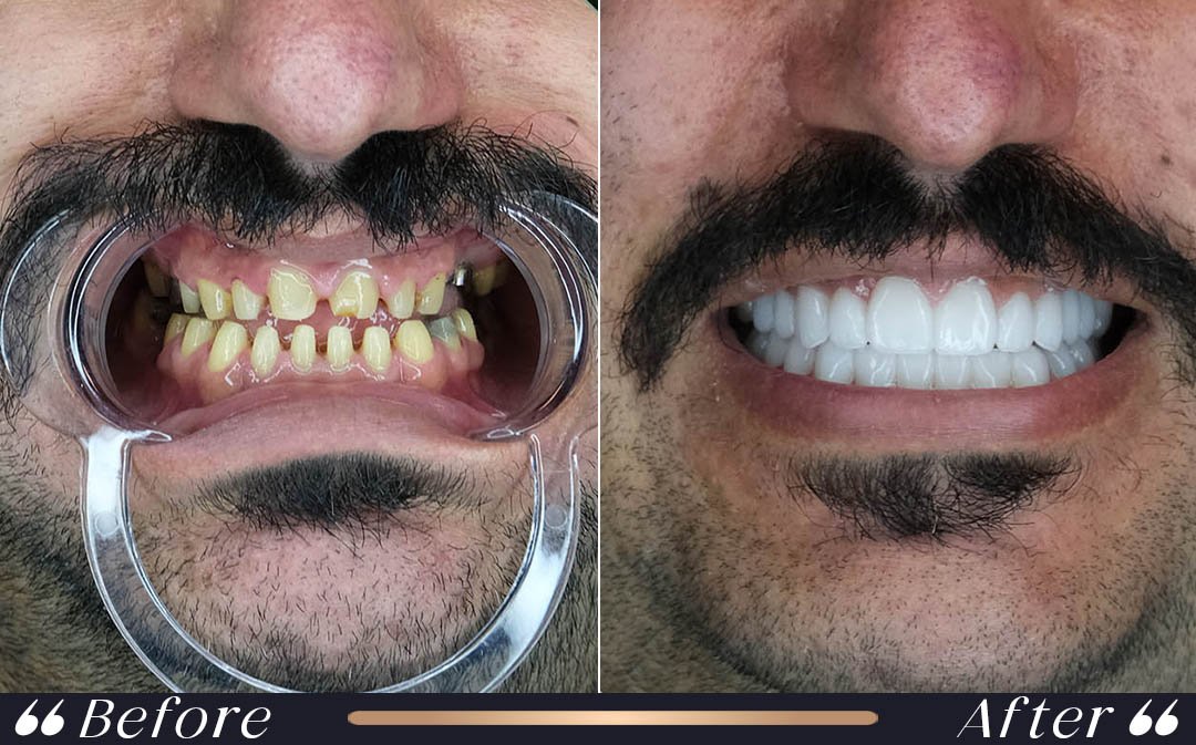 veneers vs zirconium crowns professional dental treatment at Yesilkoy Clinic