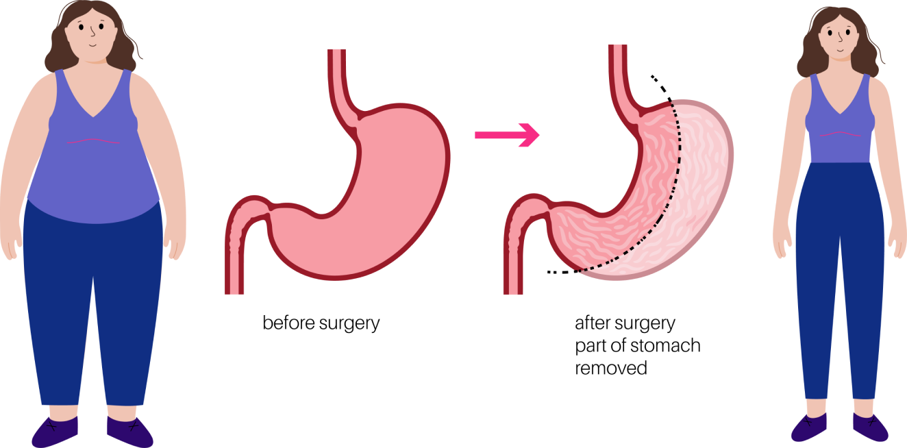 gastric balloon vs gastric sleeve comparison at Yesilkoy Clinic