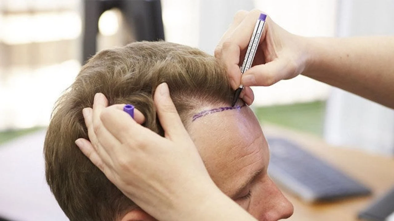 fue vs dhi professional hair transplant at Yesilkoy Clinic